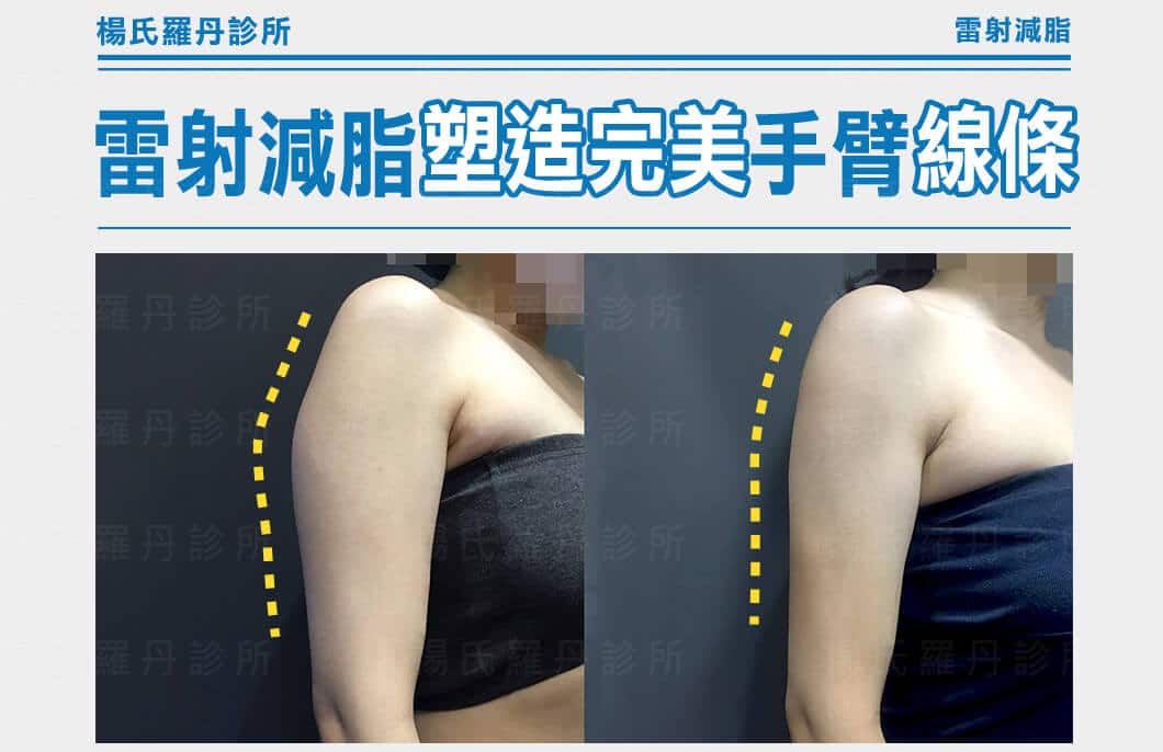 【雷射減脂】對付手臂贅肉，雷射減脂塑造完美手臂線條